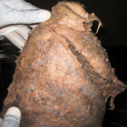 Image for - Lobar Variation of Right Lung as Seen in a Nigerian Cadaver: A Case Report