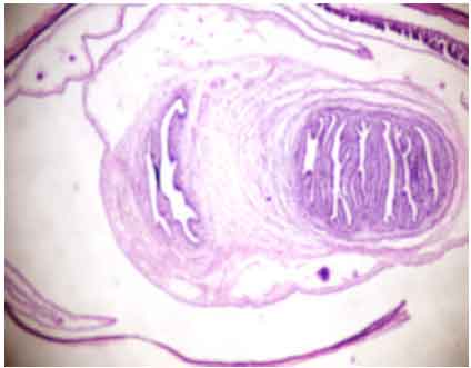 Image for - Oral Cysticercosis: A Rare Clinical Diagnosis