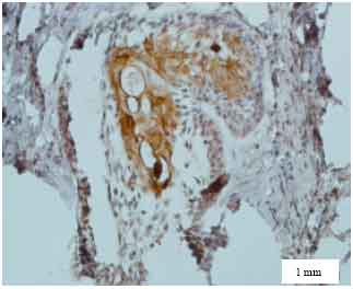 Image for - CD10 Expression in Dentigerous Cyst, Odontogenic Keratocyst and Ameloblastoma