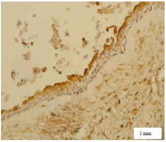 Image for - CD10 Expression in Dentigerous Cyst, Odontogenic Keratocyst and Ameloblastoma