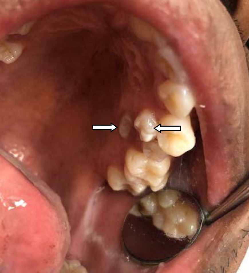 Image for - Polydent: Multiple Supplemental and Impacted Teeth: A Non-syndromic Case Report