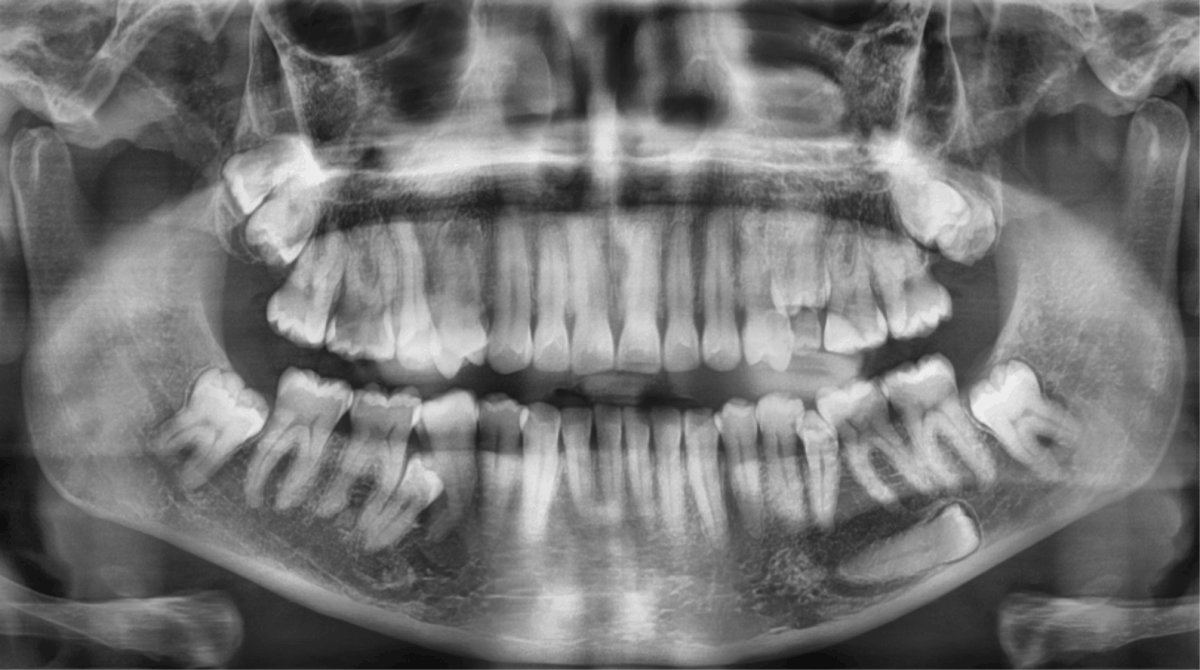 Image for - Polydent: Multiple Supplemental and Impacted Teeth: A Non-syndromic Case Report