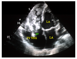 Image for - A Tricuspid Valve Endocarditis with a Large Vegetation Encroaching on the Papillary Muscle and Right Ventricular Cavity in Patient with a Ventricular Septal Defect