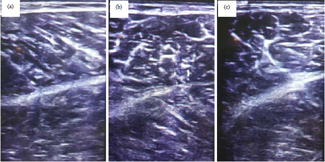 Image for - Hoffmann Syndrome: An Unusual Cause of Proximal Muscle Hypertrophy