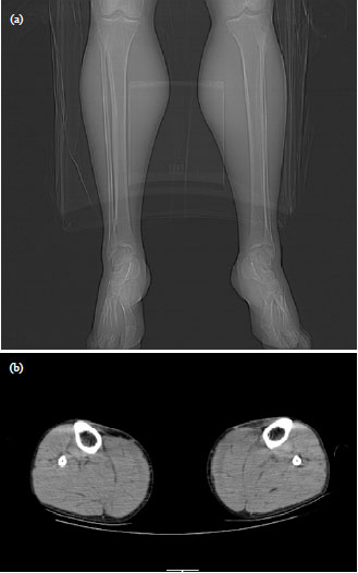 Image for - Hoffmann Syndrome: An Unusual Cause of Proximal Muscle Hypertrophy