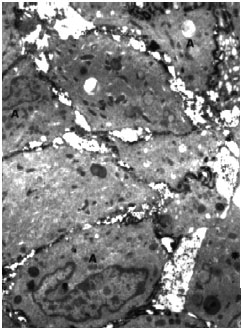 Image for - Zerumbone`s Effect on Major Histocompatibility Complex Type II Cells in Synovial Membrane of OsteoArthritic Joint