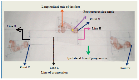 Image for - Correlation between Foot Progression Angle and Balance in Cerebral Palsied Children