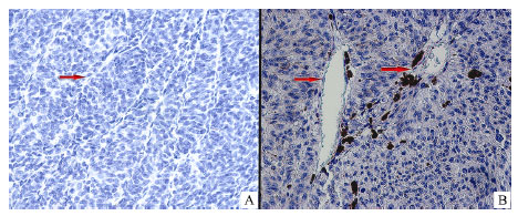 Image for - Immunohistochemical Expression of Prostate-specific Membrane Antigen in Uveal Melanoma