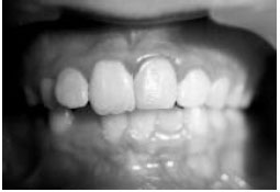 Image for - Root Fracture of an Immature Permanent Tooth with Open Apex: A Case Report