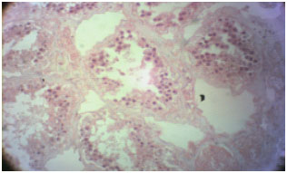 Image for - Histopathological Patterns of the Testes in Patients with Severe Burns Not Involving the Perineum (A Case Series Study)