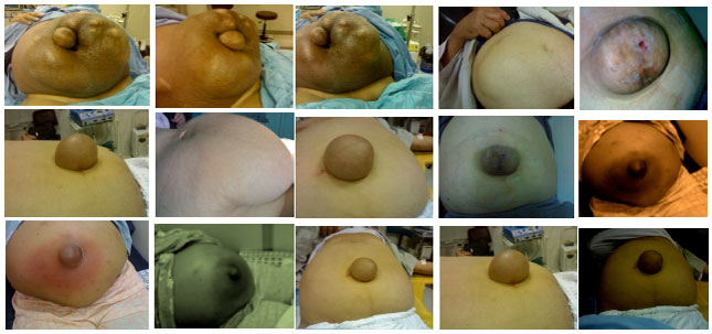 Image for - Synthetic Sapheno-peritoneal Shunts in Treatment of Refractory Ascites in Egypt