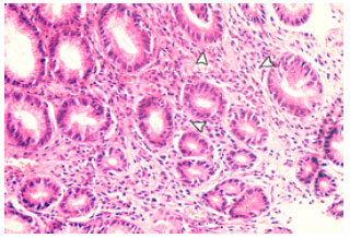 Image for - Effect of H. pylori and its Eradication on Gastric Ghrelin Secretion
