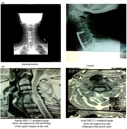 Image for - Median Cervical Corpectomy for Cervical Myelopathy Associated with Ossified Posterior Longitudinal Ligament