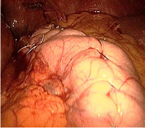 Image for - Feasibility of Laparoscopic Management of Hiatal Hernia and/or Gastroesophageal Reflux Disease with Laparoscopic Sleeve Gastrectomy or Greater Curvature Plication in Morbidly Obese Patients
