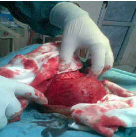 Image for - Large Thyroid Gland: A Midline Surgical Splitting Approach