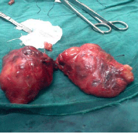 Image for - Large Thyroid Gland: A Midline Surgical Splitting Approach