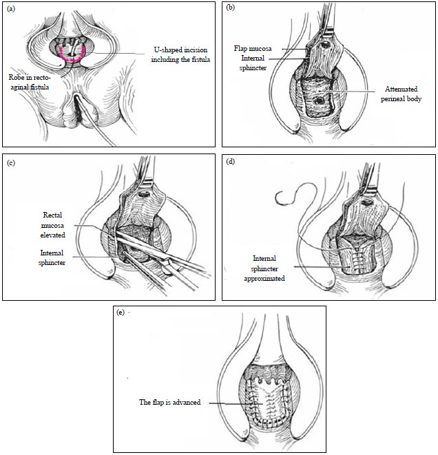 Image for - Experience with Different Surgical Procedures in Recto-Vaginal Fistula Management