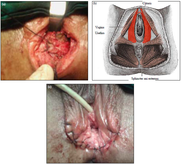 Image for - Experience with Different Surgical Procedures in Recto-Vaginal Fistula Management